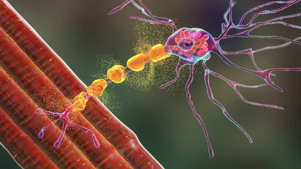 Нейрони Мозку Хворобі Тай Сакса Ілюстрація Показує Набряклі Нейрони Мембранними — стокове фото