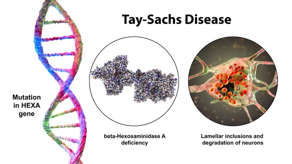 Tay Sachs病 3Dイラスト 脳神経を徐々に破壊する遺伝子障害は 六サミニダーゼA酵素の欠損につながるHexa遺伝子の遺伝子変異によって引き起こされる — ストック写真