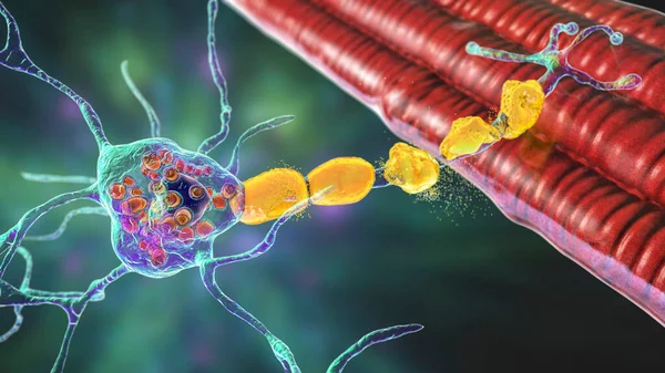 Neuroni Cerebrali Nella Malattia Tay Sachs Illustrazione Che Mostra Neuroni Fotografia Stock