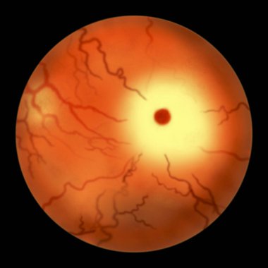 Tay-Sachs hastalığındaki göz retinası. Kiraz kırmızısı lekeli üç boyutlu illüstrasyon. Beyin nöronlarını kademeli olarak yok eden genetik bozukluk, HEXA genindeki genetik mutasyondan kaynaklanır.