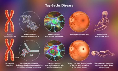 Tay-Sachs disease, 3D illustration. A genetic disorder that progressively destroys brain neurons, is caused by a mutation in the HEXA gene of chromosome 15 leading to deficiency of hexosaminidase A clipart