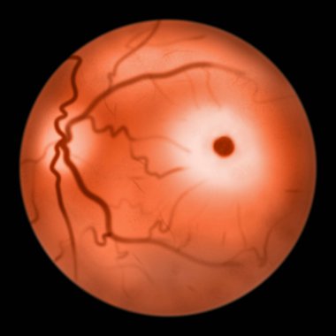 Eye retina in sphingolipid storage diseases, 3D illustration. Macular cherry red spot. Tay-Sachs disease and Niemann Pick disease clipart