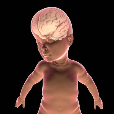 A child with macrocephaly, enlarged brain, hypotony, mental and motor delay, 3D illustration. Pathologic macrocephaly with megalencephaly, genetic disorders clipart