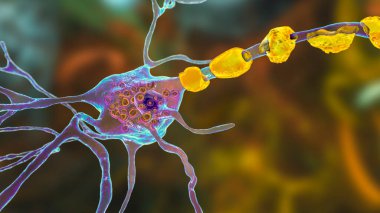 Lysosomal depolama hastalıklarındaki beyin nöronları, Tay-Sachs, Niemann-Pick, Fabry ve diğerleri. 3 boyutlu illüstrasyon, lizozomlardaki gangliositlerin birikmesine bağlı olarak lamellar eklentiler ile şişmiş nöronları gösteriyor.