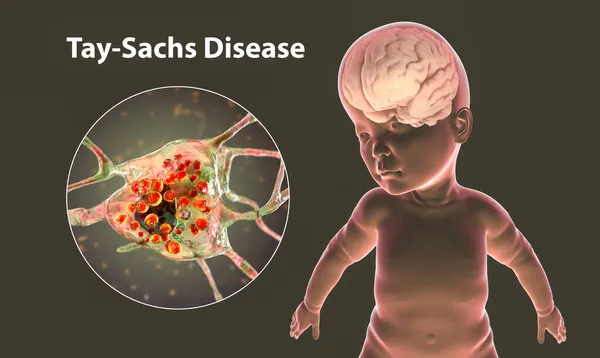 Tay Sachs Kór Egy Lizoszomális Tárolási Genetikai Rendellenesség Illusztráció Makrocephaliás — Stock Fotó