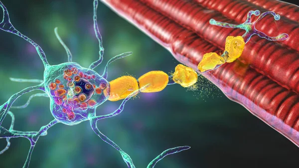 Brain neurons in Tay-Sachs disease, 3D illustration showing swollen neurons with membraneous lamellar inclusions due to accumulation of gangliosides in lysosomes and demyelination