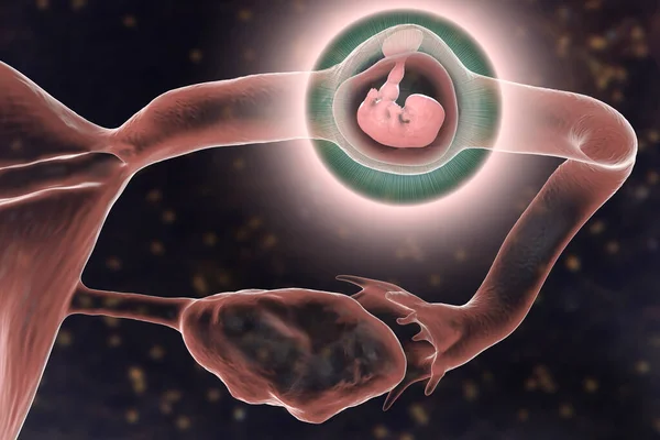 Ciąża Pozamaciczna Jajowodów Ilustracja Pokazująca Tygodniowy Płód Ludzki Wszczepiony Jajowodu — Zdjęcie stockowe