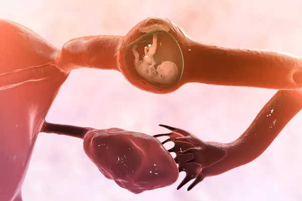 Tubal ectopic pregnancy, 3D illustration showing an 8-week human fetus implanted in the fallopian tube instead of uterus