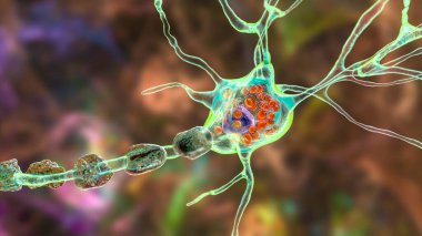 Lysosomal depolama hastalıklarındaki beyin nöronları, Tay-Sachs, Niemann-Pick, Fabry ve diğerleri. 3 boyutlu illüstrasyon, lizozomlardaki gangliositlerin birikmesine bağlı olarak lamellar eklentiler ile şişmiş nöronları gösteriyor.