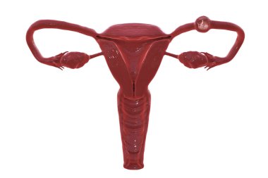 Tüpten dış gebelik, 3 boyutlu illüstrasyon, dölyatağı tüpüne rahim yerine 8 haftalık insan fetüsü yerleştirildiğini gösteriyor.