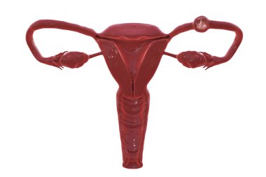 Tubal ectopic pregnancy, 3D illustration showing an 8-week human fetus implanted in the fallopian tube instead of uterus clipart