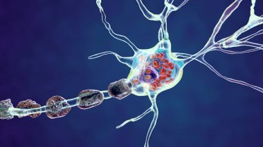 Lysosomal depolama hastalıklarındaki beyin nöronları, Tay-Sachs, Niemann-Pick, Fabry ve diğerleri. 3 boyutlu illüstrasyon, lizozomlardaki gangliositlerin birikmesine bağlı olarak lamellar eklentiler ile şişmiş nöronları gösteriyor.