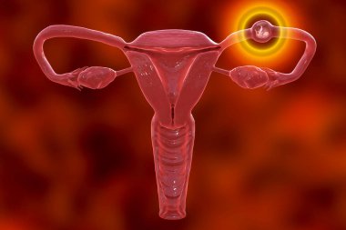 Tüpten dış gebelik, 3 boyutlu illüstrasyon, dölyatağı tüpüne rahim yerine 8 haftalık insan fetüsü yerleştirildiğini gösteriyor.