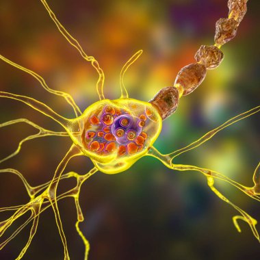 Lysosomal depolama hastalıklarındaki beyin nöronları, Tay-Sachs, Niemann-Pick, Fabry ve diğerleri. 3 boyutlu illüstrasyon, lizozomlardaki gangliositlerin birikmesine bağlı olarak lamellar eklentiler ile şişmiş nöronları gösteriyor.