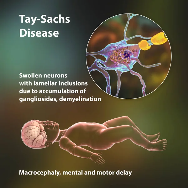 Tay Sachs Disease Lysosomal Storage Genetic Disorder Illustration Child Macrocephaly — Stock Photo, Image