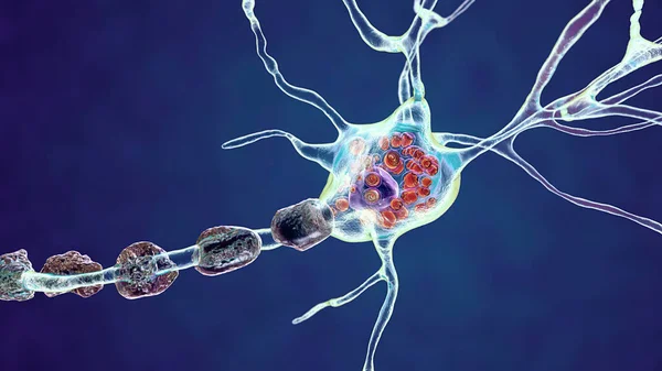 Brain neurons in lysosomal storage diseases, Tay-Sachs, Niemann-Pick, Fabry and other. 3D illustration showing swollen neurons with lamellar inclusions due to accumulation of gangliosides in lysosomes