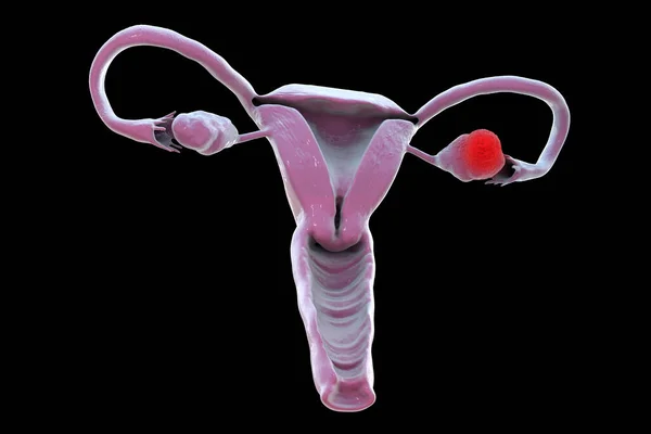 Cáncer Ovario Ilustración Que Muestra Tumor Maligno Ovario Izquierdo — Foto de Stock