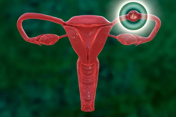 Tubal ectopic pregnancy, 3D illustration showing an 8-week human fetus implanted in the fallopian tube instead of uterus