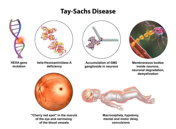 Tay-Sachs disease, 3D illustration. A genetic disorder that progressively destroys brain neurons, is caused by a mutation in the HEXA gene of chromosome 15 leading to deficiency of hexosaminidase A