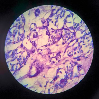 Tiroid foliküler karsinom, hafif mikrograf, mikroskop altında fotoğraf.