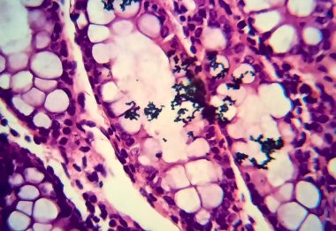 Bacillary dysentery, light micrograph, photo under microscope showing presence of bacteria and accumulation of inflammatory cells in intestinal epithelium. High magnification clipart