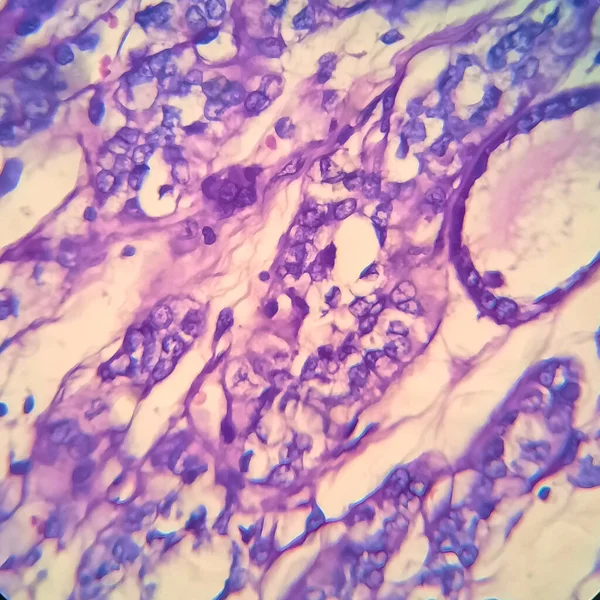 Carcinoma Folicular Tiroideo Micrografía Ligera Foto Bajo Microscopio — Foto de Stock