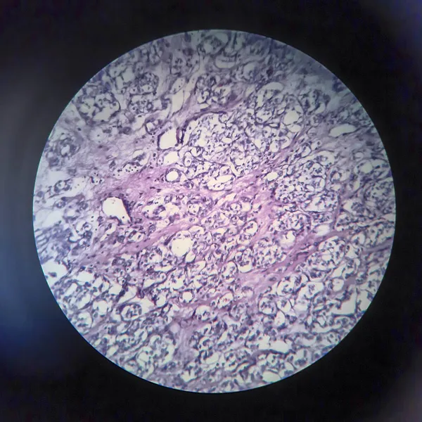 Carcinoma Follicolare Tiroideo Microscopio Leggero Foto Microscopio — Foto Stock