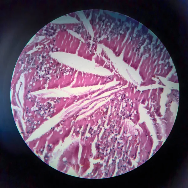 Gruczolakorak Tarczycy Mikrograf Świetlny Zdjęcie Pod Mikroskopem — Zdjęcie stockowe