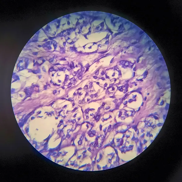 Carcinoma Folicular Tiroideo Micrografía Ligera Foto Bajo Microscopio —  Fotos de Stock