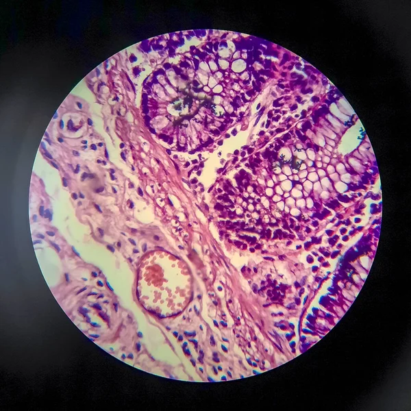 腸上皮内細菌の存在と炎症細胞の蓄積を示す顕微鏡下での背側赤痢 軽いマイクログラフ — ストック写真