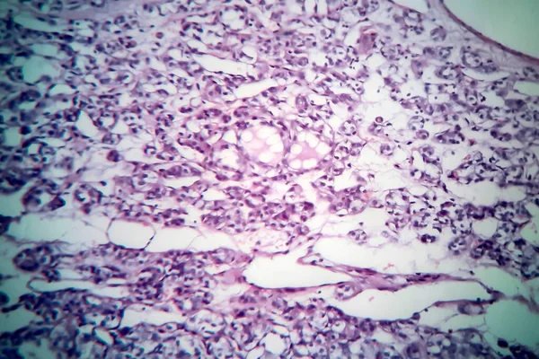 Karcinom Štítné Žlázy Lehký Mikrograf Fotografie Pod Mikroskopem — Stock fotografie