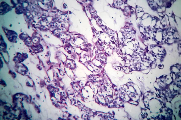 Carcinoma Folicular Tireóide Micrografia Luz Foto Sob Microscópio — Fotografia de Stock