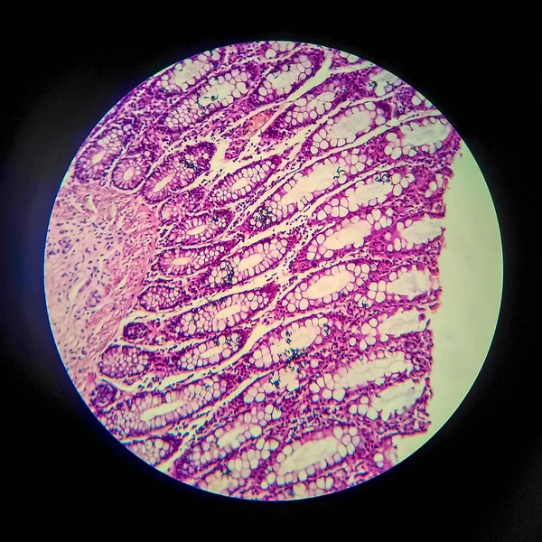 腸上皮内細菌の存在と炎症細胞の蓄積を示す顕微鏡下での背側赤痢 軽いマイクログラフ — ストック写真