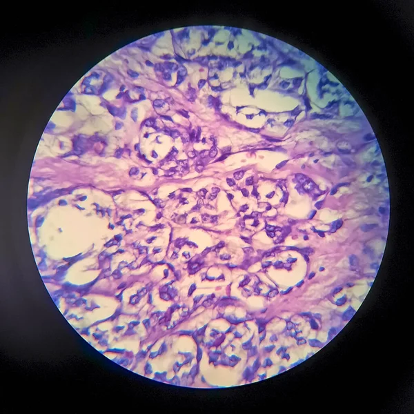 Sköldkörtelfollikulärt Karcinom Ljusmikrograf Foto Mikroskop — Stockfoto