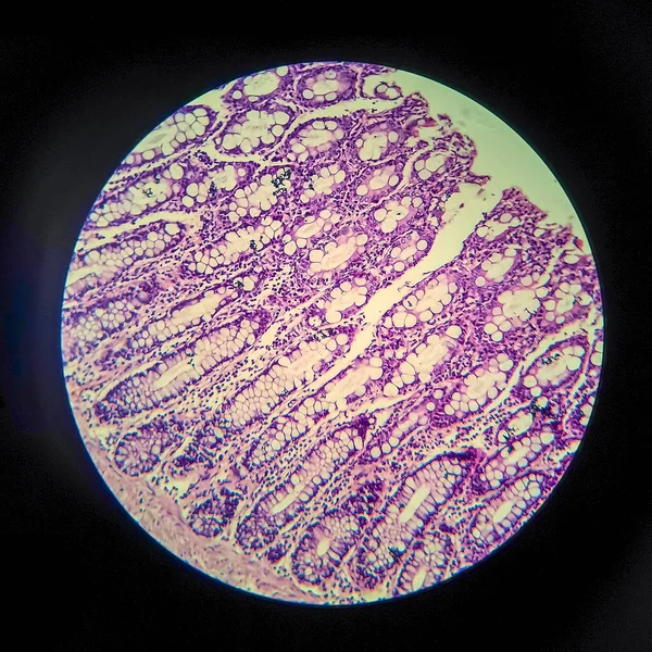 Bacillary Dysentery Light Micrograph Photo Microscope Showing Presence Bacteria Accumulation — Stock Photo, Image