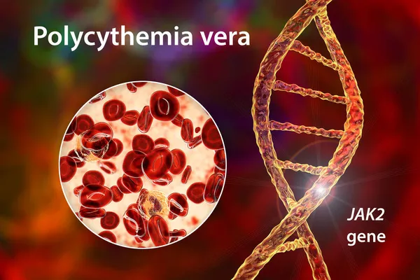 卵巢癌是一种罕见的血癌 由于Jak2基因突变 其体内红血球数量增加 三维图像显示血管内红血球丰富 — 图库照片