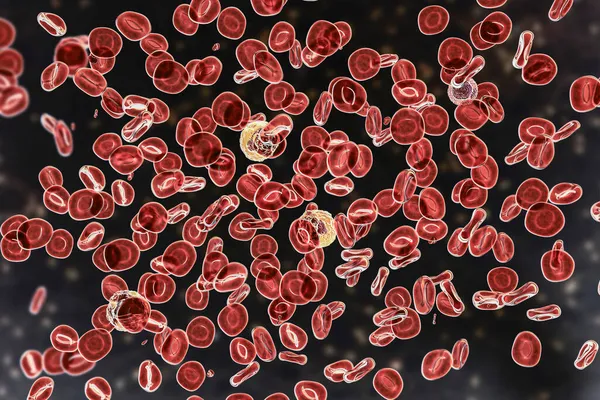 Polycythemia Vera Raro Cáncer Sangre Crecimiento Lento Con Aumento Número —  Fotos de Stock