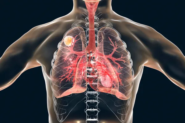 Akciğerde Aspergilloma Boyutlu Illüstrasyon Miketom Mantar Topu Olarak Bilinir Bağışıklık — Stok fotoğraf