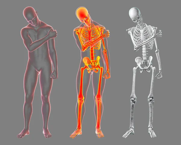 Боль Плече Концептуальная Иллюстрация Набор Человеческих Тел Скелетом Болезненном Положении — стоковое фото