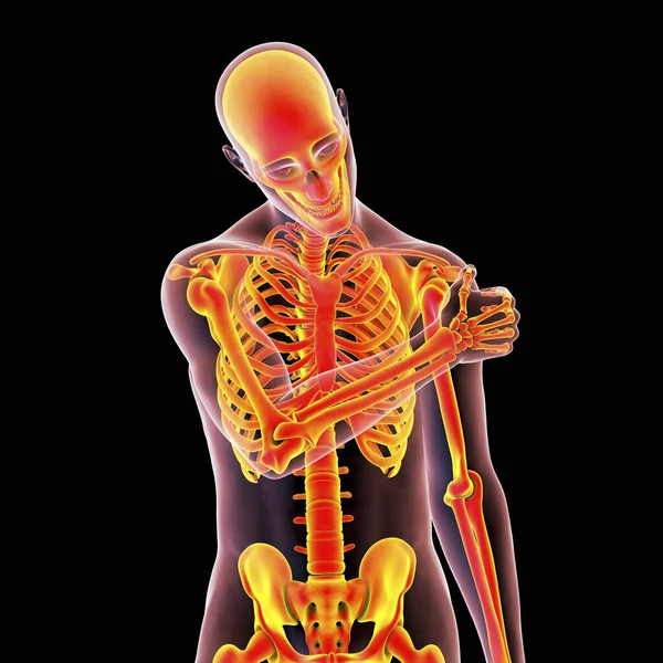 Shoulder Pain Conceptual Illustration Showing Human Male Body Highlighted Skeleton — Fotografia de Stock