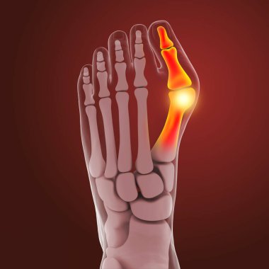 Ayak parmağı deformasyonu, hallux valgus olarak da bilinir, ya da nasır, 3 boyutlu illüstrasyon.