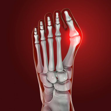 Ayak parmağı deformasyonu, hallux valgus olarak da bilinir, ya da nasır, 3 boyutlu illüstrasyon.