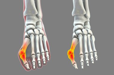 Ayak parmağı deformasyonu, hallux valgus olarak da bilinir, ya da nasır, üç boyutlu çizim hallux valgus ile ayak ve hallux valgus ile izole iskelet