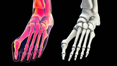 Ayak parmağı deformasyonu, hallux valgus olarak da bilinir, ya da nasır, üç boyutlu çizim hallux valgus ile ayak ve hallux valgus ile izole iskelet