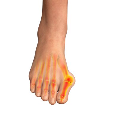Ayak parmağı deformasyonu, hallux valgus olarak da bilinir, ya da nasır, 3 boyutlu illüstrasyon.