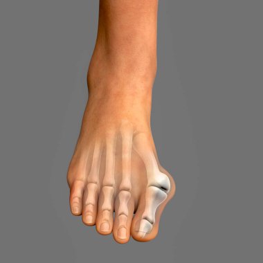 Ayak parmağı deformasyonu, hallux valgus olarak da bilinir, ya da nasır, 3 boyutlu illüstrasyon.