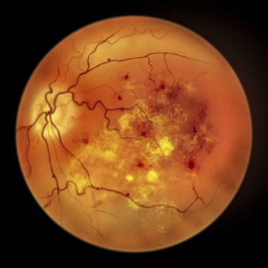 Diabetic retinopathy, ophthalmoscope view, illustration showing accumulation of fatty substances leaked from blocked capillaries (yellow patches), haemorrhages (red spots), microaneurysms clipart