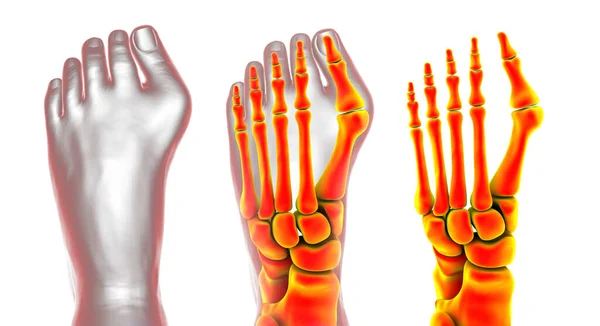 Παραμόρφωση Των Ποδιών Επίσης Γνωστή Hallux Valgus Bunion Εικονογράφηση — Φωτογραφία Αρχείου