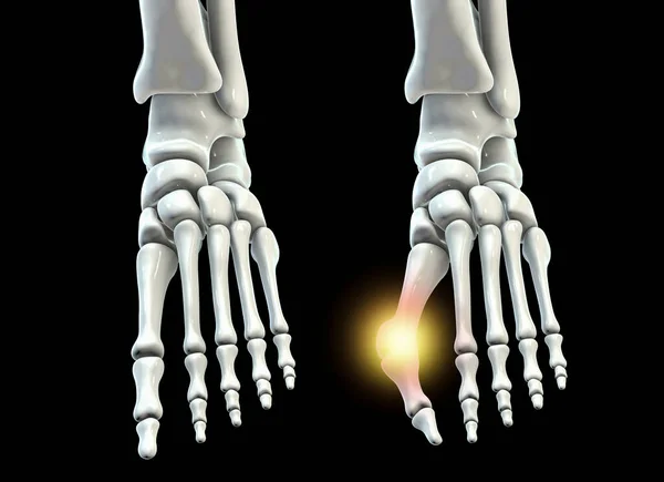 脚趾变形 也被称为Hallux Valgus 或Bunion 3D插图显示正常的脚跟骨骼和Hallux Valgus — 图库照片
