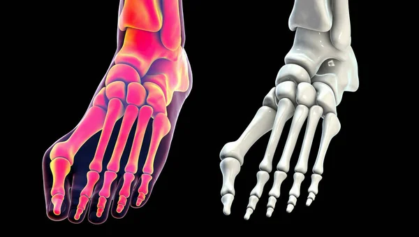 Deformazione Delle Dita Nota Anche Come Alluce Valgo Bunion Illustrazione — Foto Stock